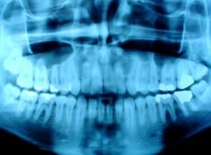 teeth xrays